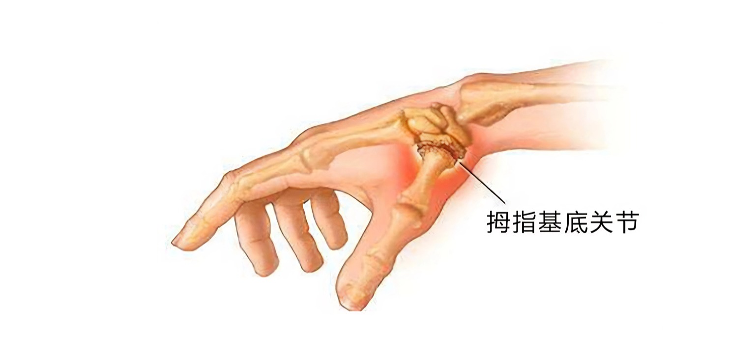 拇指基底关节.jpg